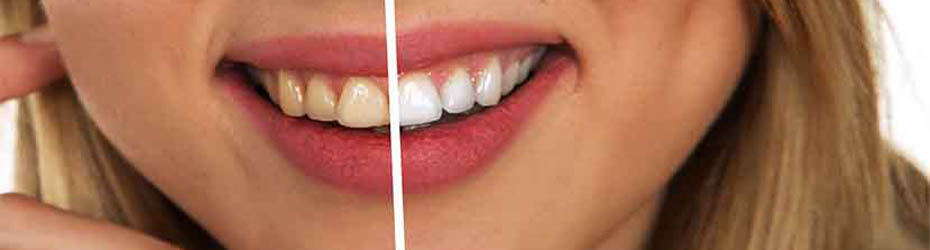 Does Coffee Permanently Stain Your Teeth?